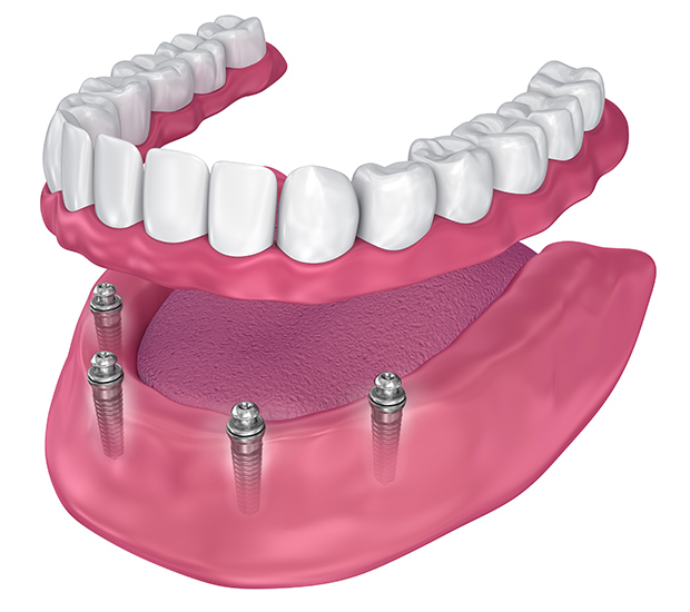 all-on-4-dental-implants illustration