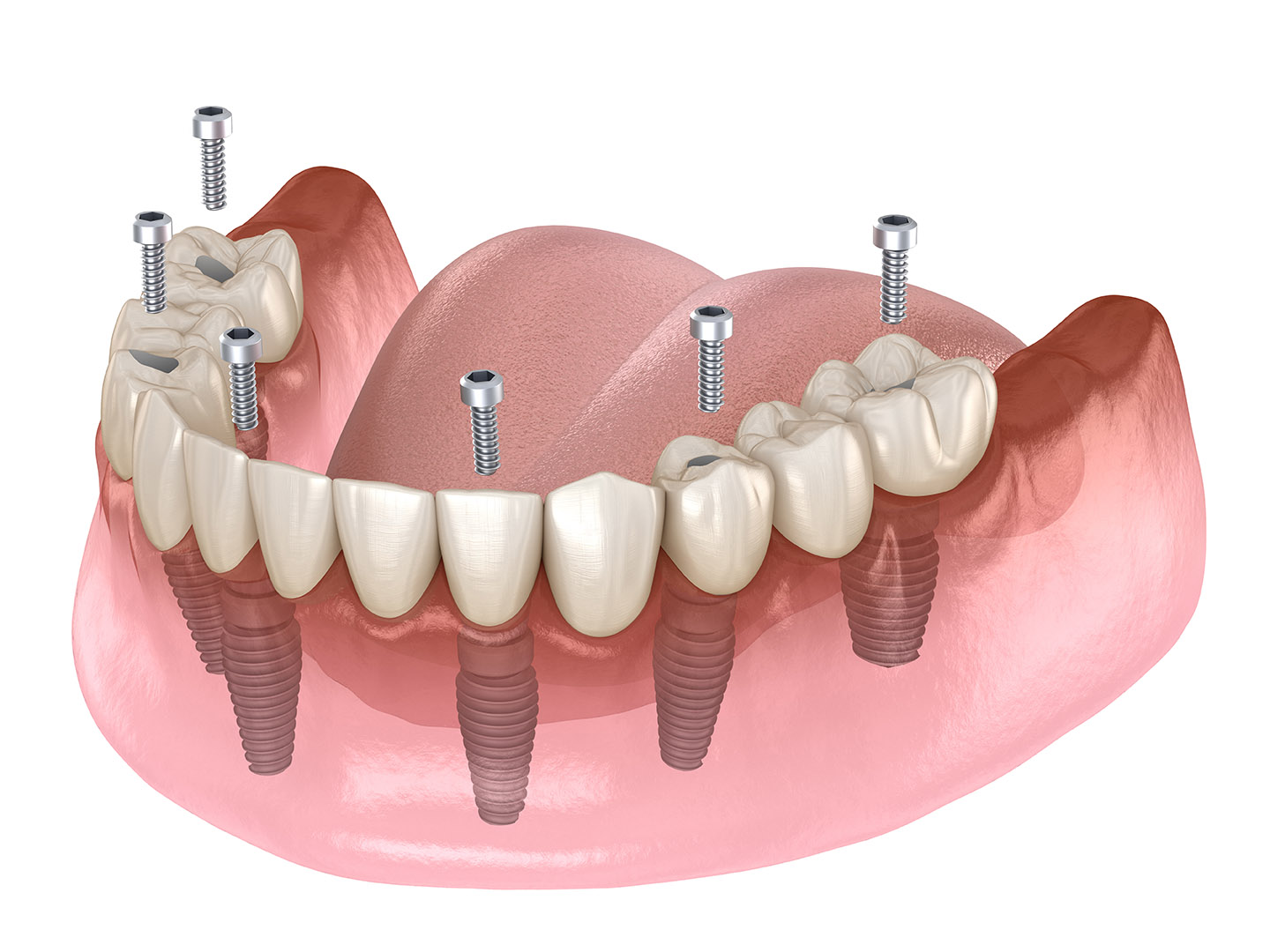 Mandibular prosthesis All on 4 system supported by implants, screw fixation. Medically accurate 3D illustration of dental concept